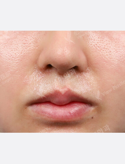 Rejuran Healer + Chin Filler (1 month) — After