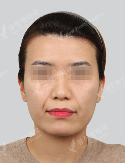 Shrink + contour injection + nasolabial filler + co2 + chin point removal (1 month) — Before