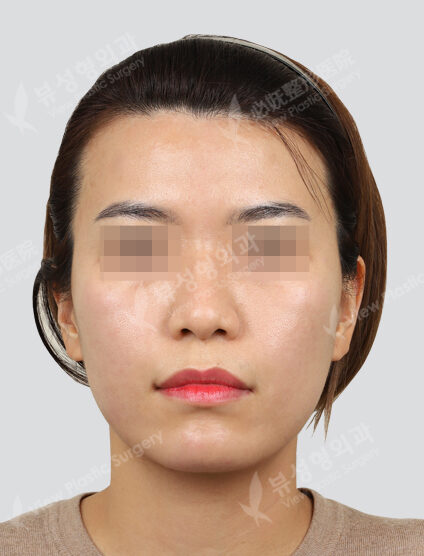Shrink + contour injection + nasolabial filler + co2 + chin point removal (1 month) — After
