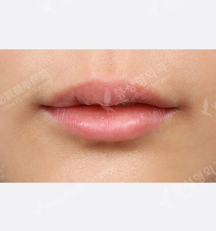 Lip + lip filler (1 month) — Before