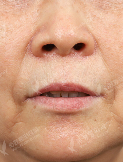 Filler (nasolabial folds, lips) (1 month) — Before