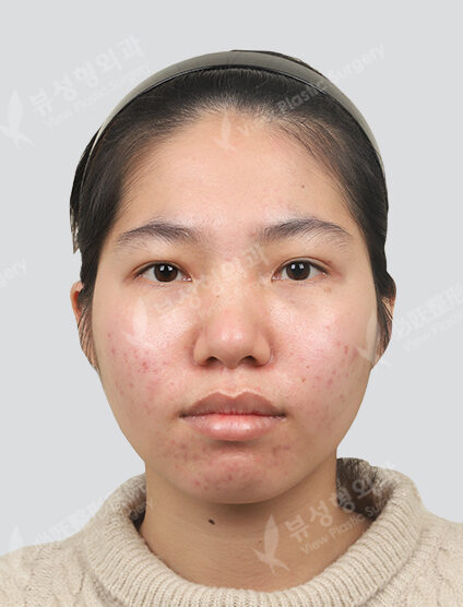 Fraxel + PRP 3 times (3 months) — Before