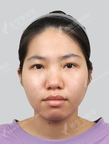 Fraxel + PRP 3 times (3 months) — After