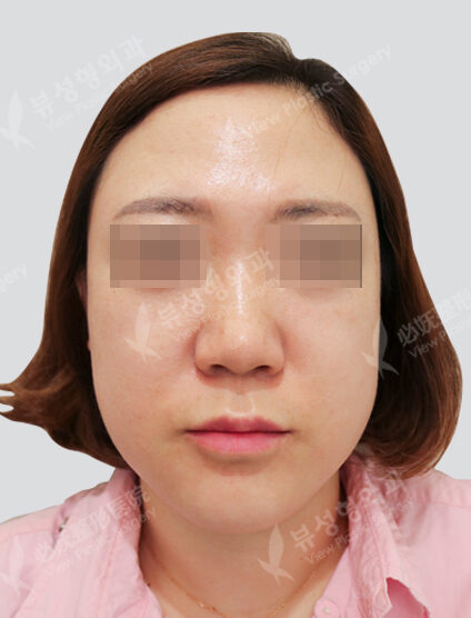 Ulthera + chin botox + lip filler + lip filler + lip botox (1 month) — Before