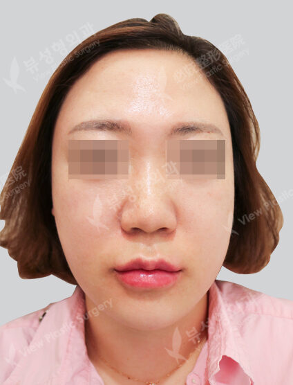 Ulthera + chin botox + lip filler + lip filler + lip botox (1 month) — After