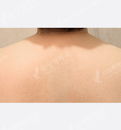 trapezius botox (1 month) — Before