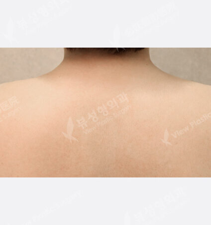 trapezius botox (1 month) — After