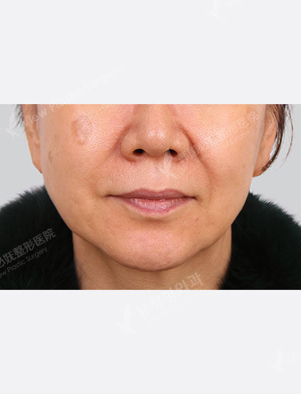 Laser Toning (1 month) — Before