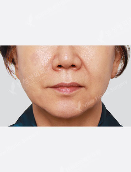 Laser Toning (1 month) — After