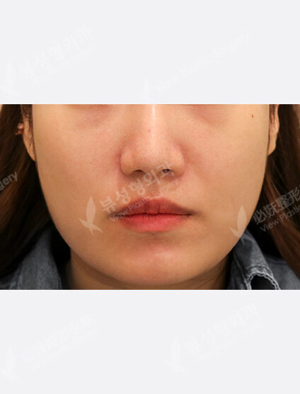 3 times contour injection (6 months) — Before