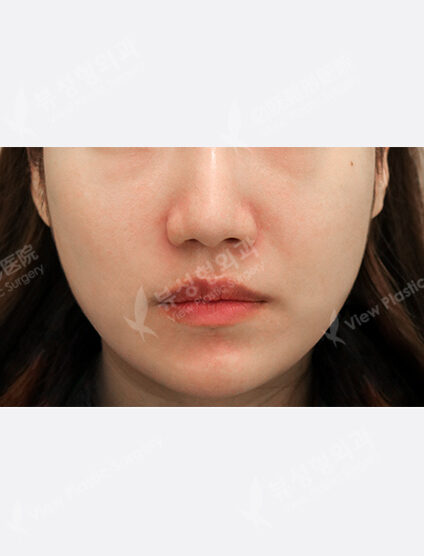 3 times contour injection (6 months) — After