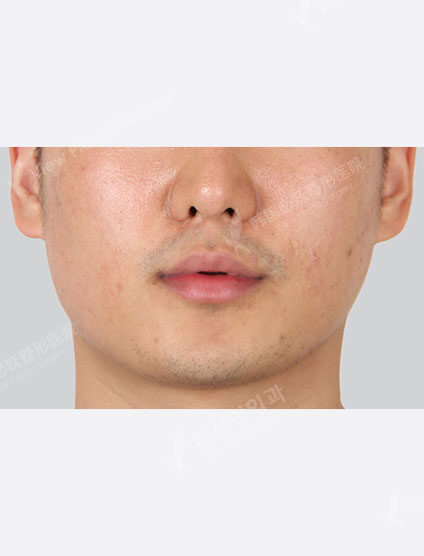 Acne management (1 month) — Before
