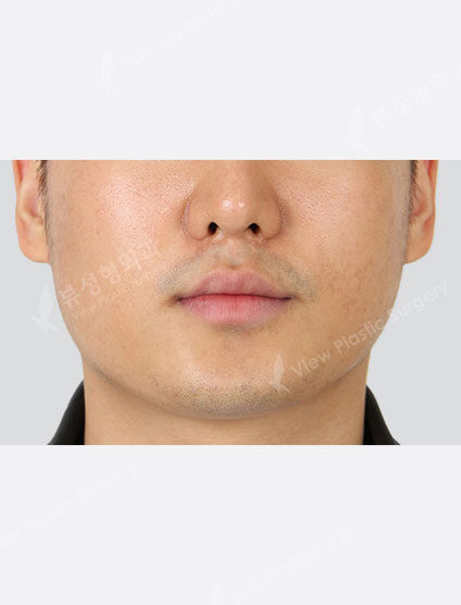 Acne management (1 month) — After