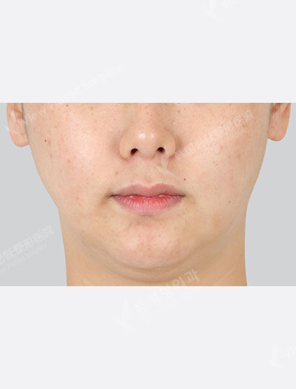 Toning Laser (1 month) — Before