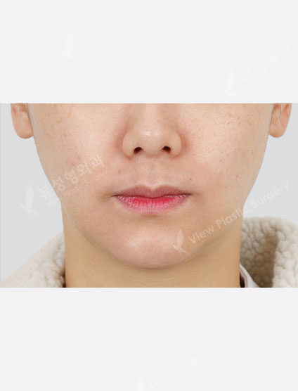 Toning Laser (1 month) — After