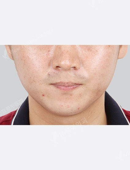 Vitamin C whitening care (1 month) — Before