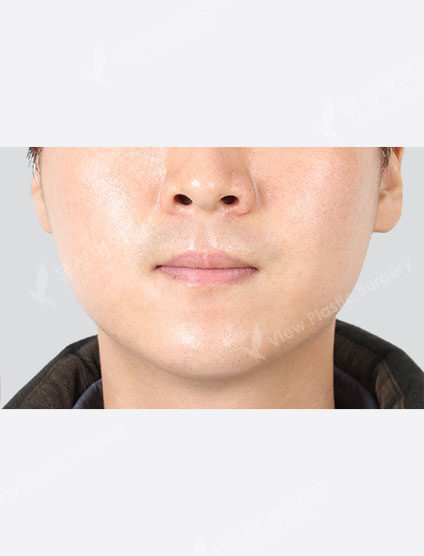 Vitamin C whitening care (1 month) — After