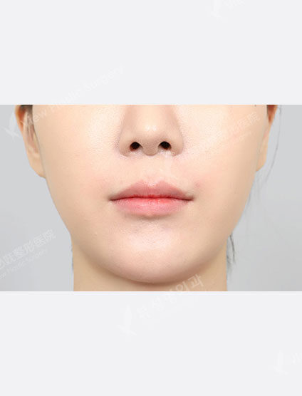 Lip filler (1 month) — Before