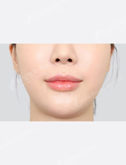 Lip filler (1 month) — After