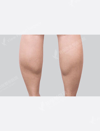 Calf Botox (1 month) — Before