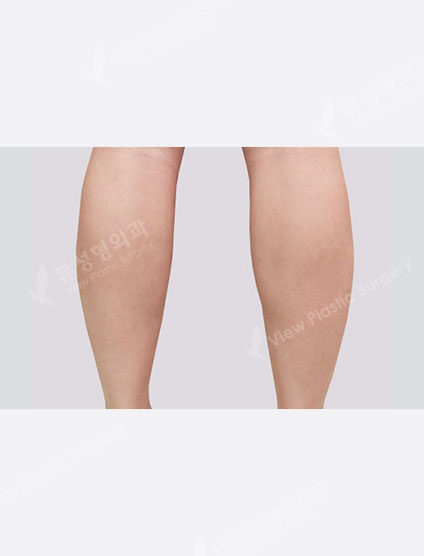 Calf Botox (1 month) — After