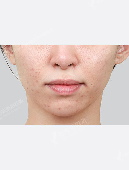 Rejuran Healer (1 month) — Before