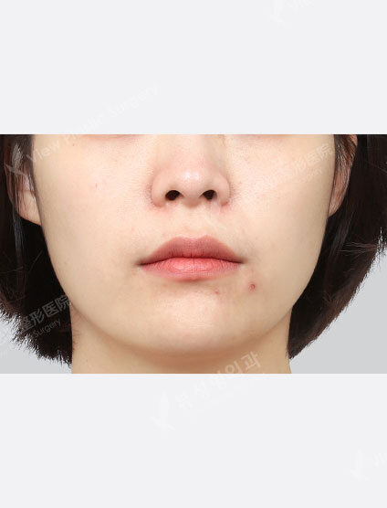 Toning (1 month) — Before