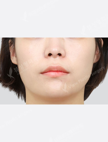 Toning (1 month) — After