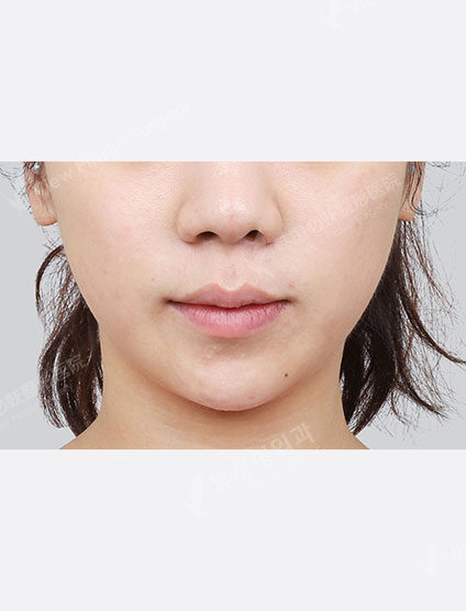 Rejuran Healer (1 month) — Before