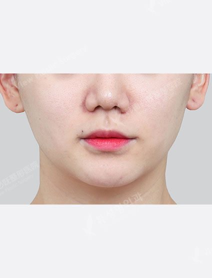 Shrink (1 month) — Before