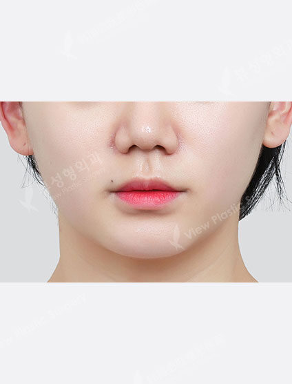 Shrink (1 month) — After