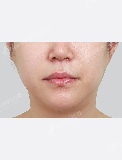 Rejuran Healer (1 month) — Before