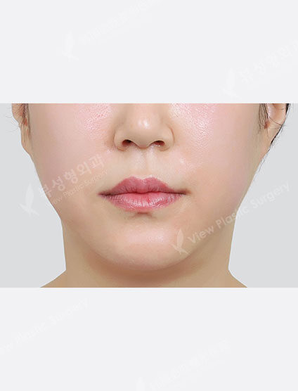 Rejuran Healer (1 month) — After