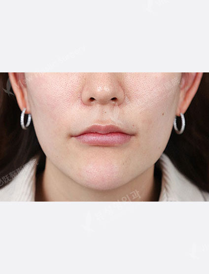 Vivace (1 month) — Before