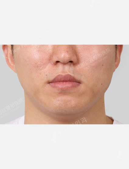 Nose filler, forehead botox (1 month) — Before