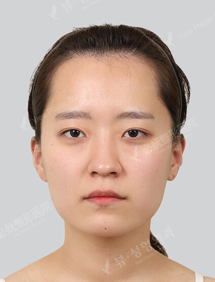 Double chin, chin line lifting focus (1 month) — Before