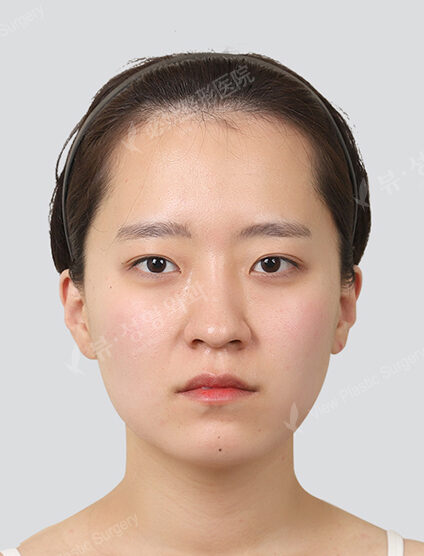 Double chin, chin line lifting focus (1 month) — After