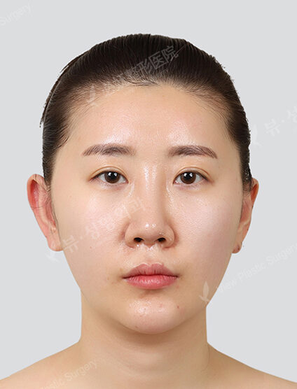 Water glow, whitening focus (1 month) — After