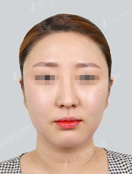 Forehead filler, forehead botox, forehead botox (1 month) — Before