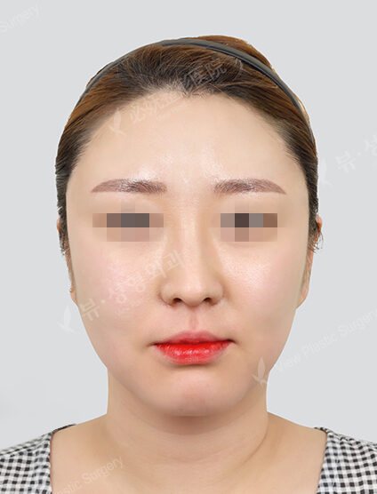Forehead filler, forehead botox, forehead botox (1 month) — After