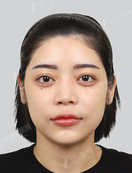 Shrink, Botox (1 month) — Before