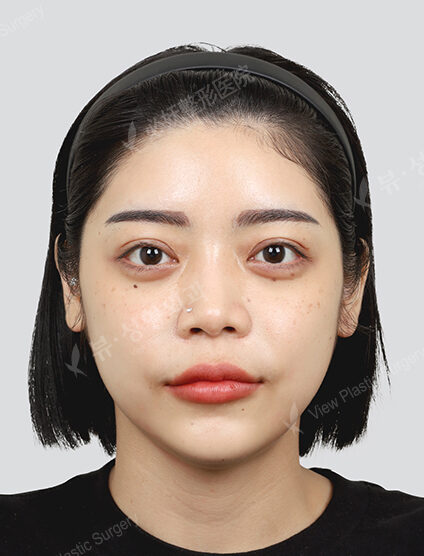 Shrink, Botox (1 month) — After