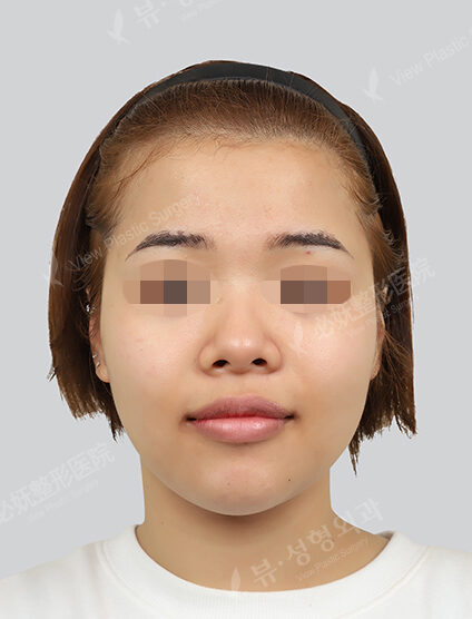 Water light treatment (1 month) — Before