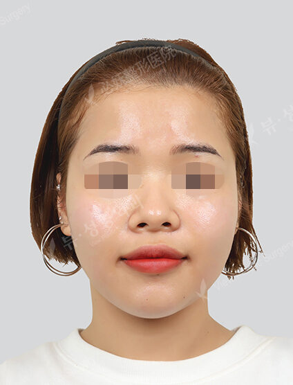 Water light treatment (1 month) — After