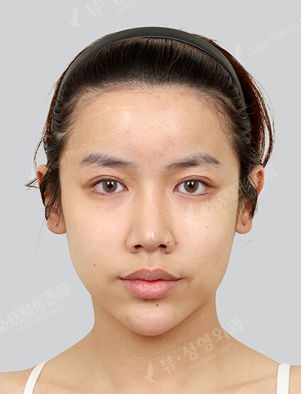 Water light treatment, skin botox, forehead botox (1 month) — Before