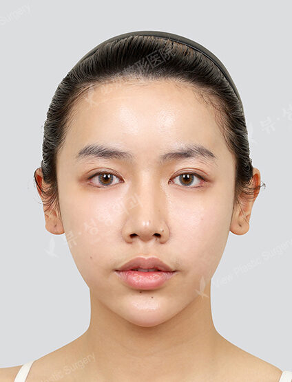 Water light treatment, skin botox, forehead botox (1 month) — After