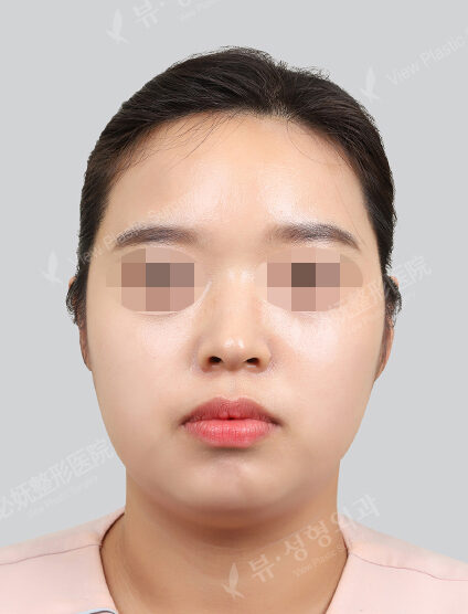 Chin filler (1 month) — Before