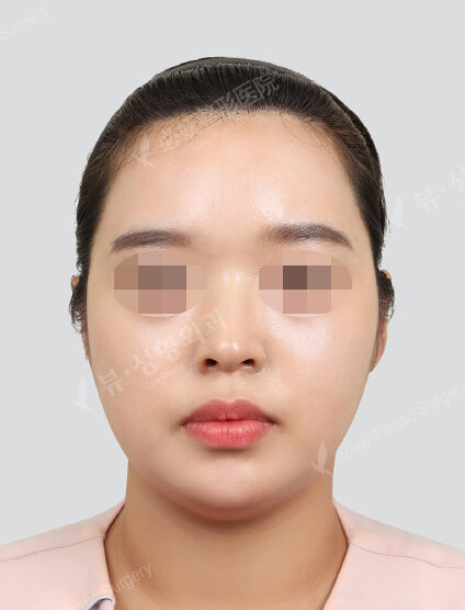 Chin filler (1 month) — After