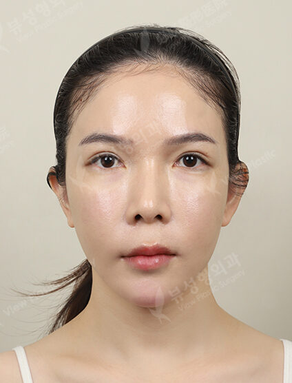 Ulthera (1 month) — After