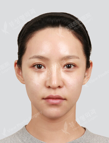 Fraxel, PRP 3 times (1 month) — After